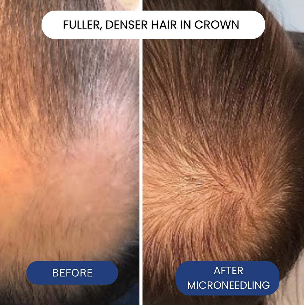 Saç Çıkarma Mikro İğneleme Ser - Ingrown Hair Serum incelemesi ve fiyatı